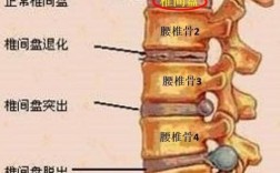 腰椎间盘突出的位置是哪里？（腰间盘突出单位是）