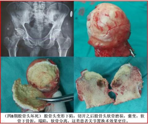 骨盆骨缝十级伤残赔偿标准？单位定培-图2