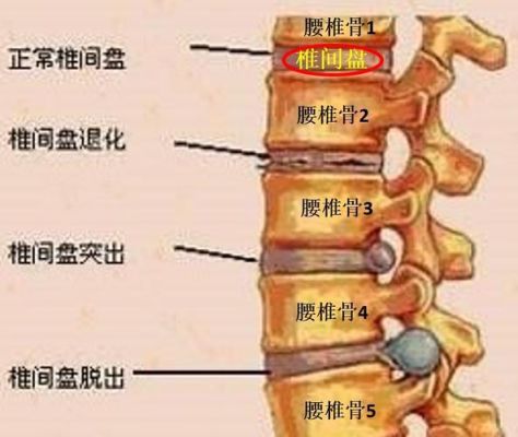 腰椎间盘突出的位置是哪里？（腰间盘突出单位是）-图1