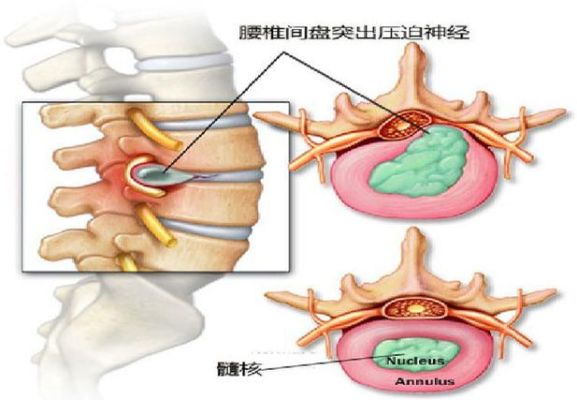 腰椎间盘突出的位置是哪里？（腰间盘突出单位是）-图2